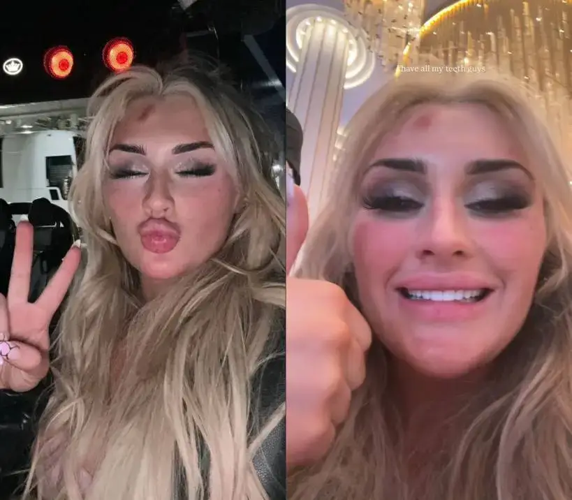 A split-image selfie of Tiffany Stratton. On the left, she puckers her lips and holds up a peace sign. On the right, she smiles to show she did not have a teeth injury, with text above her head saying "I have all my teeth guys".