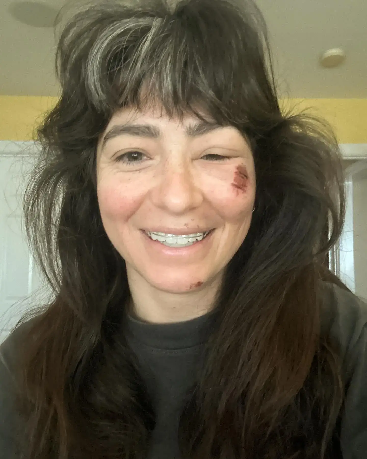 A close-up selfie of Melissa Villaseñor smiling with messy hair and visible scrapes on her cheek and chin.